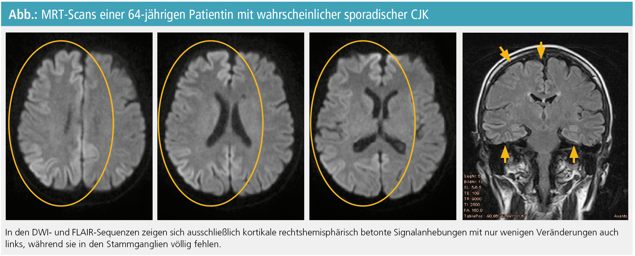 Creutzfeldt-Jakob-Krankheit (CJK) – ein Fallbericht | Neurologisch ...
